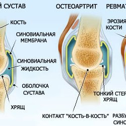 Poliartrita reumatoidă