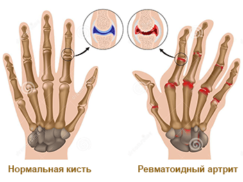 Poliartrita reumatoidă - simptome și tratament