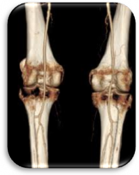 РКТ (МСКТ) кісток і суглобів