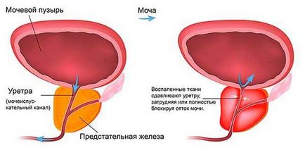 Найефективніші трави від простатиту