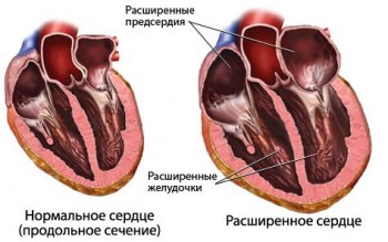 Шийний остеохондроз і артеріальний тиск