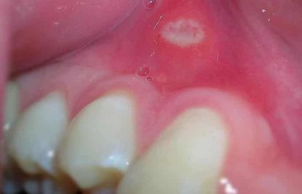 A szifilisz a szájban - Photo fertőzés az emberi szájüregben