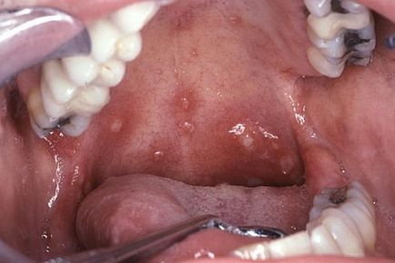 A szifilisz a szájban - Photo fertőzés az emberi szájüregben