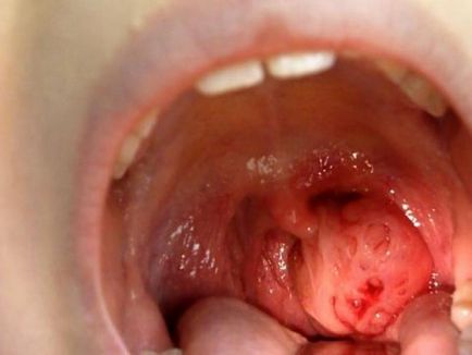 Сифіліс у роті - фото інфекції в ротовій порожнині людини
