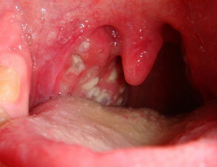 Sifilis în gură - fotografie a infecției în gura umană