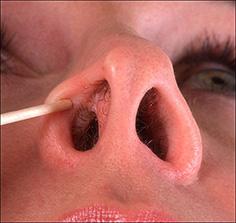 Синехії порожнини носа причини, симптоми, діагностика та лікування
