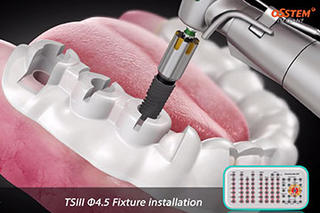 Sistem implant de implant osostem