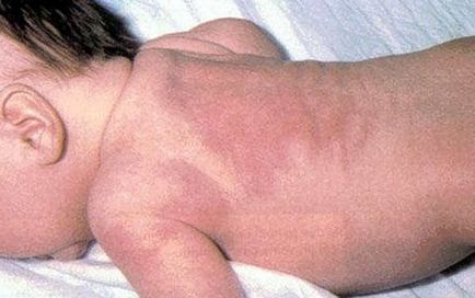 Sclera la nou-născuți semne, cauze, tratament, en-babyhealth