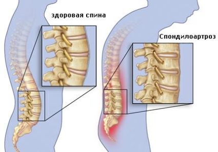 Spondilartroza coloanei vertebrale cervicale este o problemă reală pentru mulți