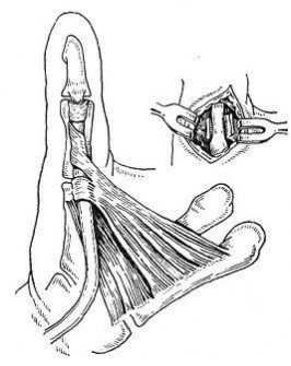Stenozarea ligamentului