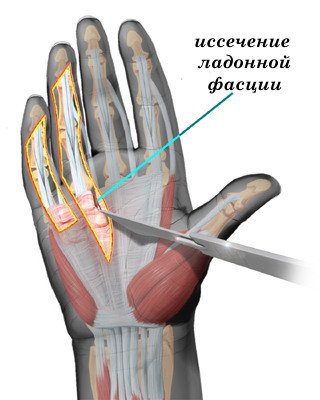 Stenozarea ligamentului sau ruperea, cauze de deget arc, semne, metode de tratament