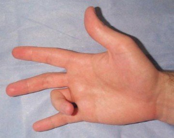 Стенозуючий лігаментит або клацали, пружний палець причини, ознаки, методи лікування