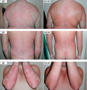 Super Psoric krém psoriasis tulajdonságait, összetételét és megjegyzések (Psoric) Super rüh psoriasis krém tulajdonságai, összetétele és vélemények