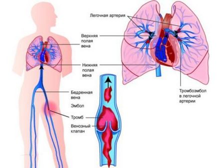 Tromboflebita din plămâni sunt principalele simptome, uflebologa