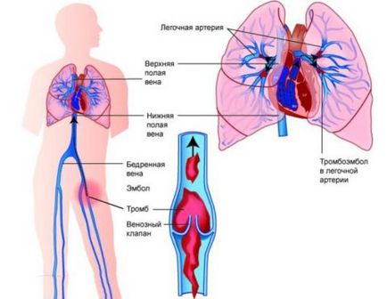 Тромбофлебіт легких основні симптоми, uflebologa