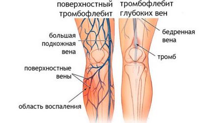 Тромбофлебіт легких основні симптоми, uflebologa