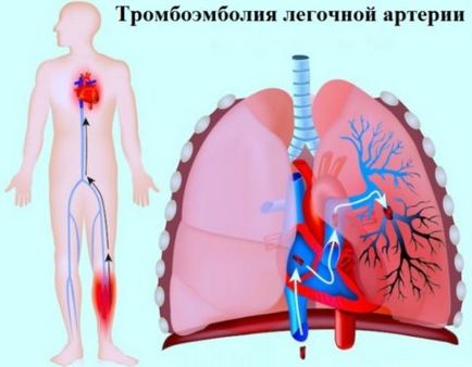 Тромбофлебіт легких основні симптоми, uflebologa