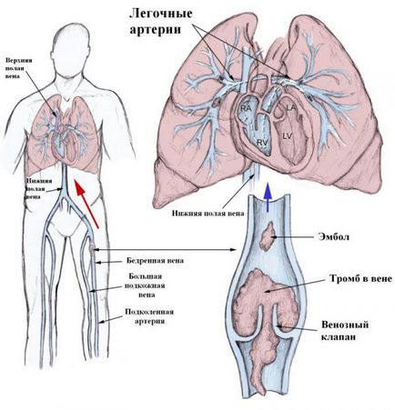 Tromboflebita cauzata de arterele pulmonare, simptome, tratament