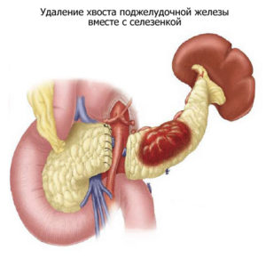 Îndepărtarea pancreasului - consecințe și viață după