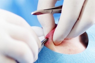 Збільшення губ имплантами опис процедури, фото до і після і відгуки