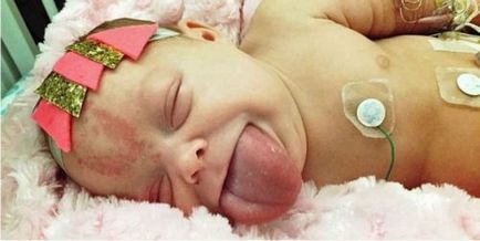 Limbă crescută a copilului, macroglossie la nou-născuți, tratament