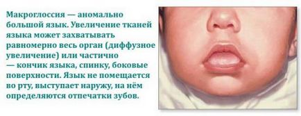 Limbă crescută a copilului, macroglossie la nou-născuți, tratament