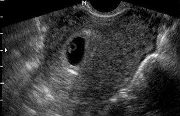 Uzi terhesség akár 11 hétig (diagnosztika) és a KDK