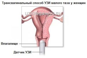 Uzi mic pelvis la femei cum să vă pregătiți pentru procedura de care aveți nevoie