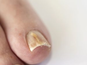 Види грибка нігтів на ногах і лікування захворювання
