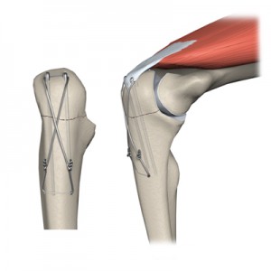 Fracturi intraarticulare