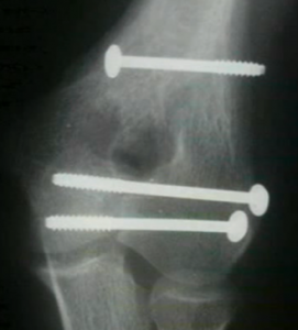 Fracturi intraarticulare