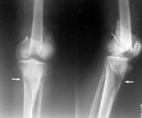 Intraarticularis törés - tünetek, diagnózis, kezelés (diagnosztika) Intraarticularis törés - tünetek, diagnózis, kezelés