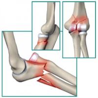 Intraarticularis törés - tünetek, diagnózis, kezelés (törés) Intraarticularis törés - tünetek, diagnózis, kezelés