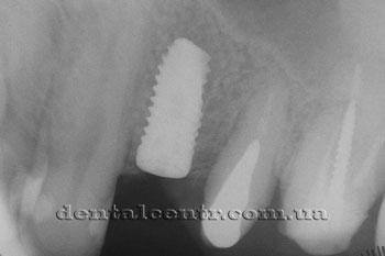 Dental temporar pentru implantare dentară în două etape în stomatologie Kcharkov