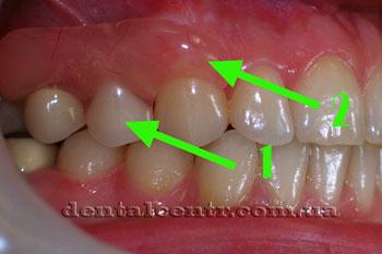 Dental temporar pentru implantare dentară în două etape în stomatologie Kcharkov