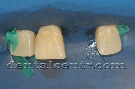 Dental temporar pentru implantare dentară în două etape în stomatologie Kcharkov