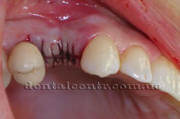 Тимчасовий зуб для двоетапної зубної імплантації в стоматології харькова