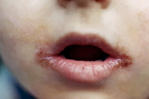 Хейліт на губах - як лікувати, фото, причини, лікування хейліту