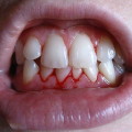 Cheilitis az ajkak - hogyan kell kezelni, fotó, okai, kezelése cheilitis