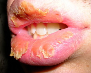 Хейліт на губах - як лікувати, фото, причини, лікування хейліту