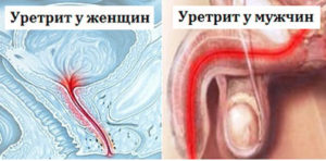 Urethrită cronică la bărbați, simptome și tratament