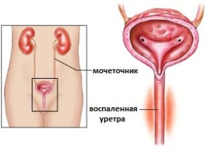 Хронічний уретрит у чоловіків, симптоми і лікування