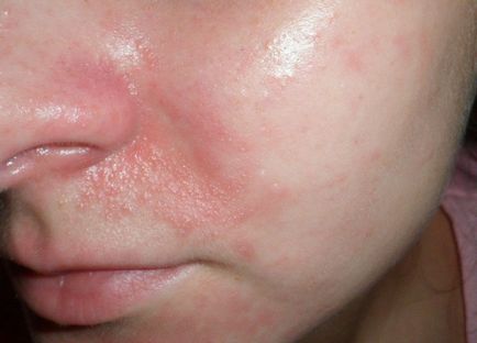 Dermatita seboreică pe față