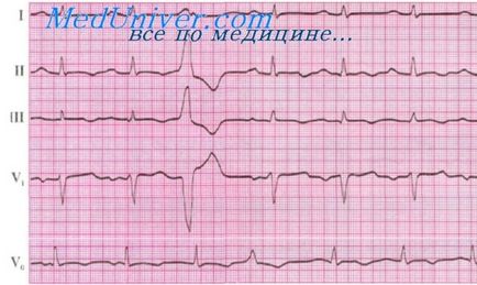 Extrasistol ventricular