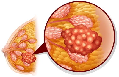 Adenoză a glandelor mamare și a formelor sale (difuz, focal, local, sclerosed), tratament,