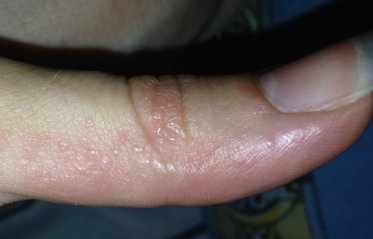 Алергія на гель лак фото, причини, лікування, стоп алергія