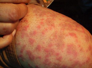 Алергія на глютен лікування у дорослих і дітей