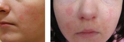 Алергія на обличчі фото, лікування, причини у дітей і дорослих