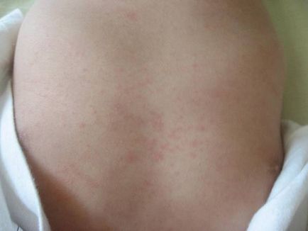 Алергія у дітей - лікування, симптоми