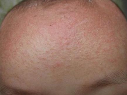 Алергія у дітей - лікування, симптоми